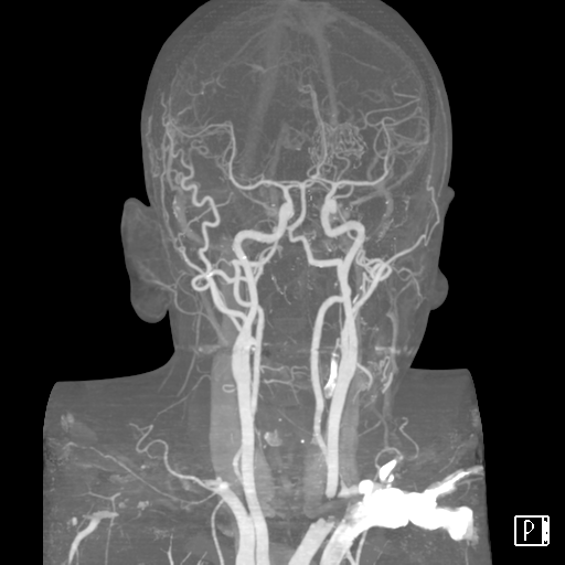 Normal CTA COW | Image | Radiopaedia.org