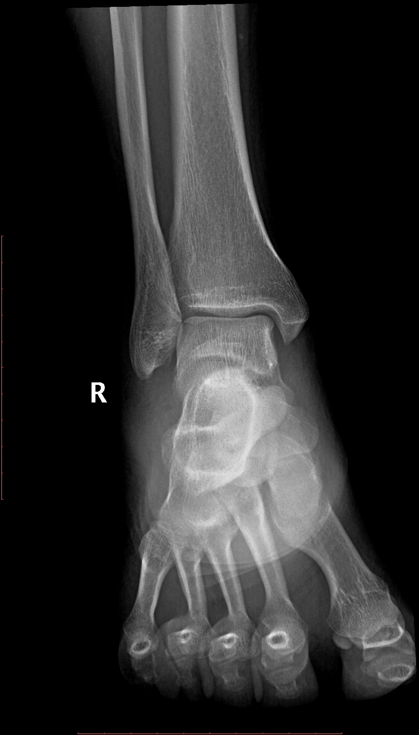 Posterior ankle impingement | Image | Radiopaedia.org