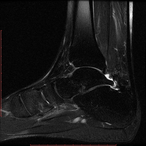 Posterior Ankle Impingement | Image | Radiopaedia.org