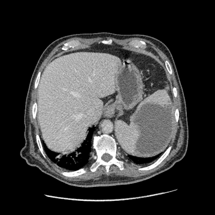 Ct Scan Of The Abdomen Showing Splenic Abscess Thin Wh Open I | My XXX ...