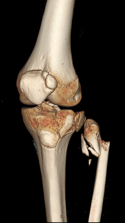 Multipartite patella | Radiology Reference Article | Radiopaedia.org