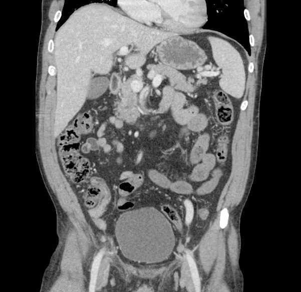 Spontaneous SMA dissection | Image | Radiopaedia.org