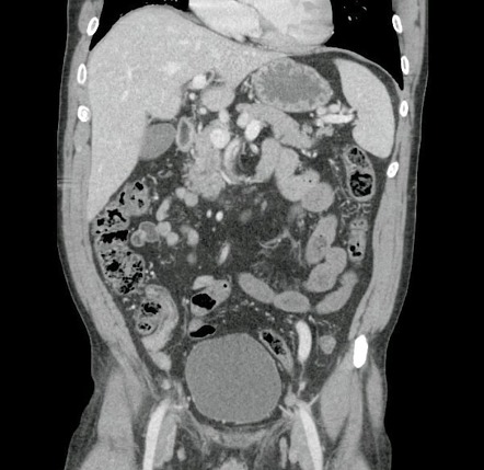 Spontaneous Sma Dissection 