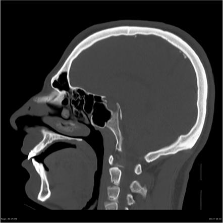 Rubinstein-Taybi syndrome with agenesis of corpus callosum