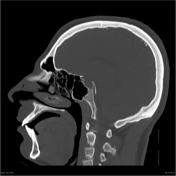 Rubinstein-Taybi syndrome 2 with cerebellar abnormality and neural