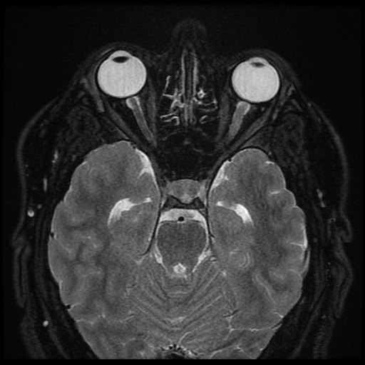 what-diseases-are-related-to-ms