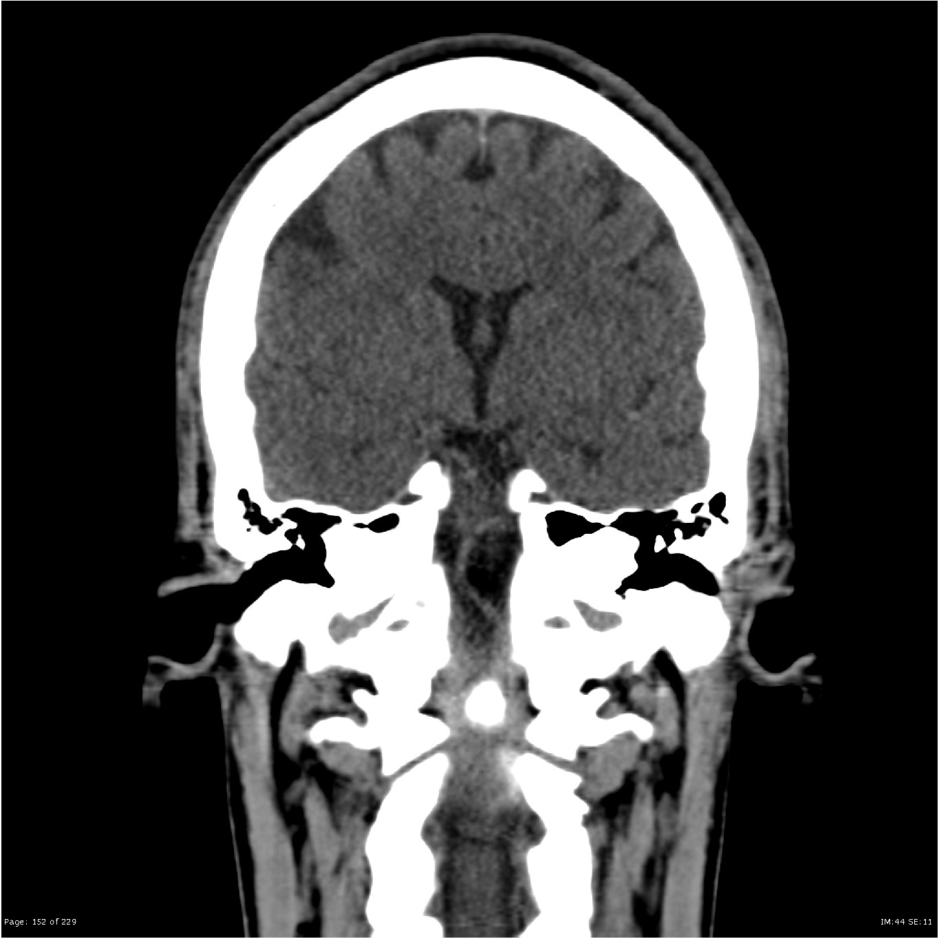 Dentocyclopedia - rubinstein taybi syndrome