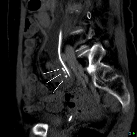 Duplex renal collecting system with ureteric calculi in upper pole ...