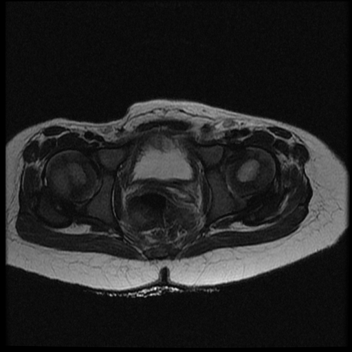 Distal femoral osteomyelitis and subperiosteal abscess | Image ...