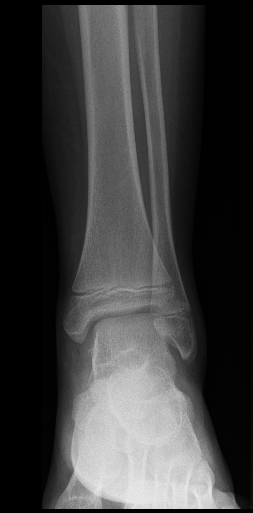 Torn Anterior Talofibular Ligament | Image | Radiopaedia.org