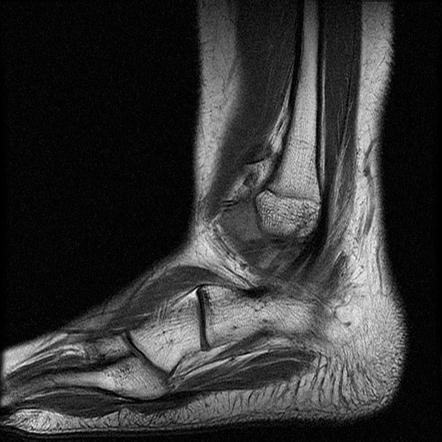 Torn anterior talofibular ligament | Image | Radiopaedia.org