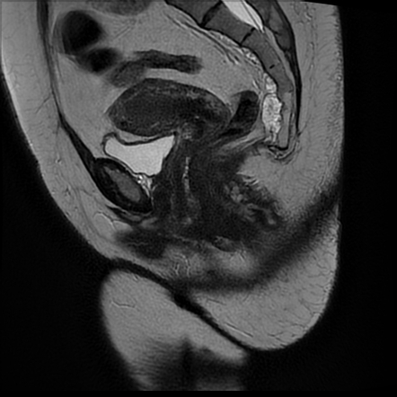 Perianal fistula (intersphincteric with intersphincteric abscess ...