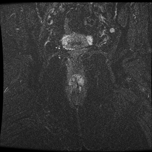 Perianal Fistula Intersphincteric With Intersphincteric Abscess Image 9069