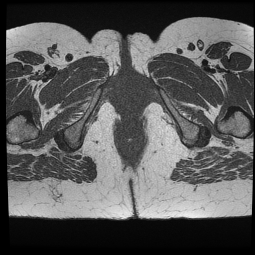 Perianal fistula (intersphincteric with intersphincteric abscess ...