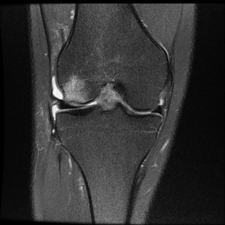 ACL acute full thickness tear - deep lateral femoral sulcus sign ...