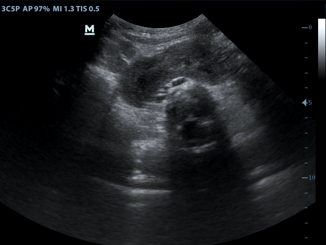 Horseshoe kidney | Image | Radiopaedia.org