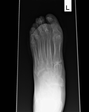 Rheumatoid Arthritis Foot Radiology Case Radiopaedia Org