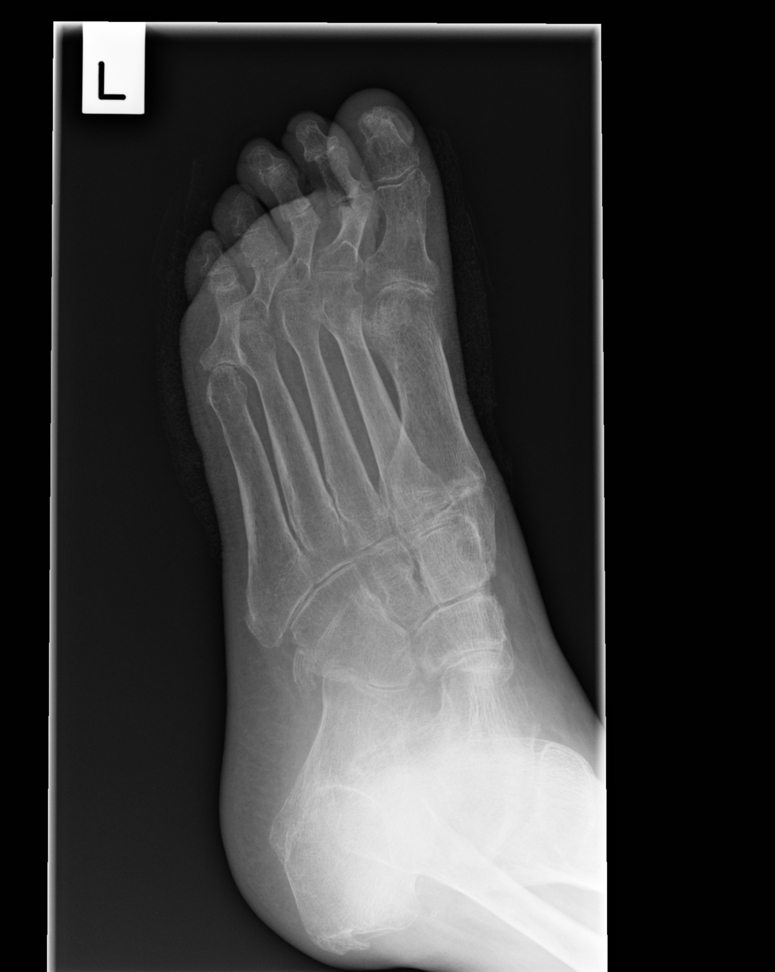 Rheumatoid Arthritis Foot Image 1518