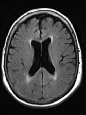 Large Ischemic Penumbra In The Right MCA Vascular Territory Image