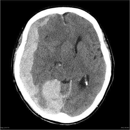 Subdural Hemorrhage Summary Radiology Reference Article