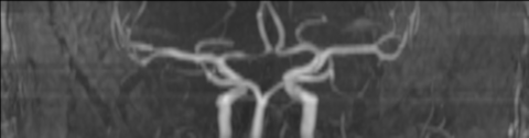 Large Ischemic Penumbra In The Right MCA Vascular Territory Image