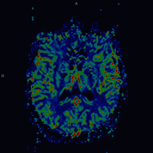 Large Ischemic Penumbra In The Right MCA Vascular Territory Image