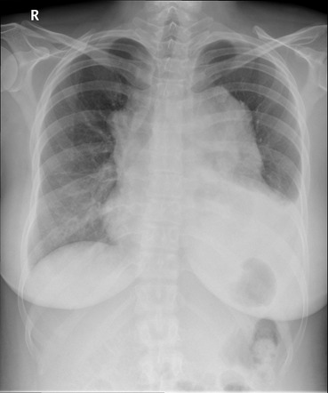 Mediastinal lymphoma | Radiology Case | Radiopaedia.org