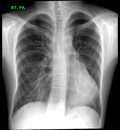 Pectus excavatum | Radiology Case | Radiopaedia.org