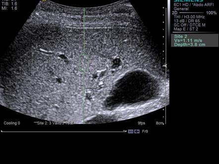 Shear wave elastography | Radiology Reference Article | Radiopaedia.org