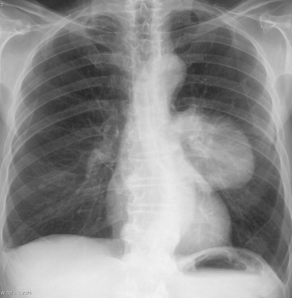 Chest X Ray Lung Cancer