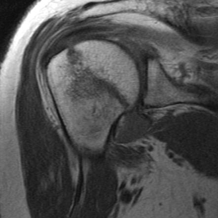 Neer Classification Of Proximal Humeral Fractures Radiology Reference Article Radiopaedia Org