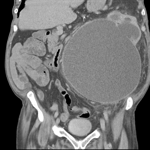 Pantaloon hernia | Image | Radiopaedia.org