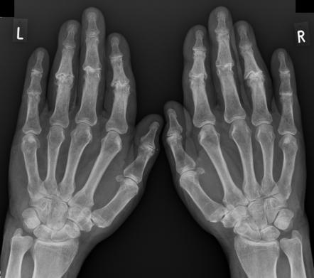 osteoarthritis radiology wrist