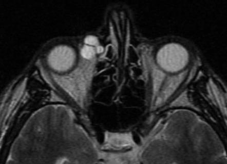 nasolacrimal cyst