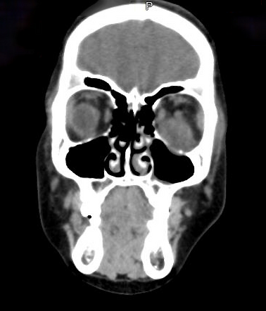 Rhabdomyosarcoma | Radiology Reference Article | Radiopaedia.org