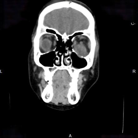 Rhabdomyosarcoma | Radiology Reference Article | Radiopaedia.org