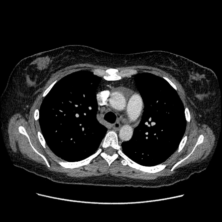 Non-specific interstitial pneumonia | Radiology Case | Radiopaedia.org