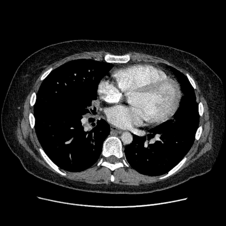 Non-specific interstitial pneumonia | Image | Radiopaedia.org