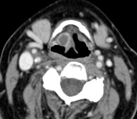 Laryngeal cyst | Radiology Reference Article | Radiopaedia.org