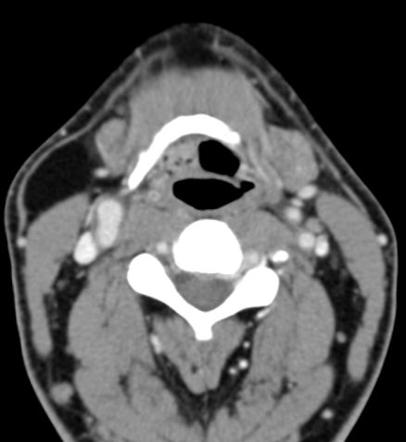 Lipoma | Radiology Reference Article | Radiopaedia.org