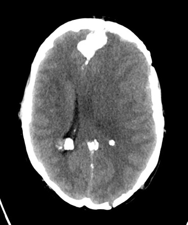 Multiple meningiomas: neurofibromatosis type 2 | Radiology Case ...