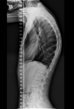 disease scheuermann lateral radiopaedia kyphosis thoracic wedging anterior vertebrae case