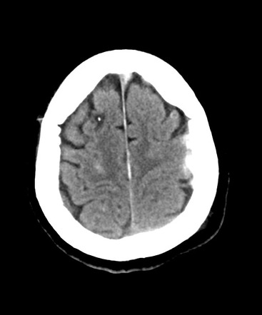 Intracranial Pressure Monitoring Chart Easy