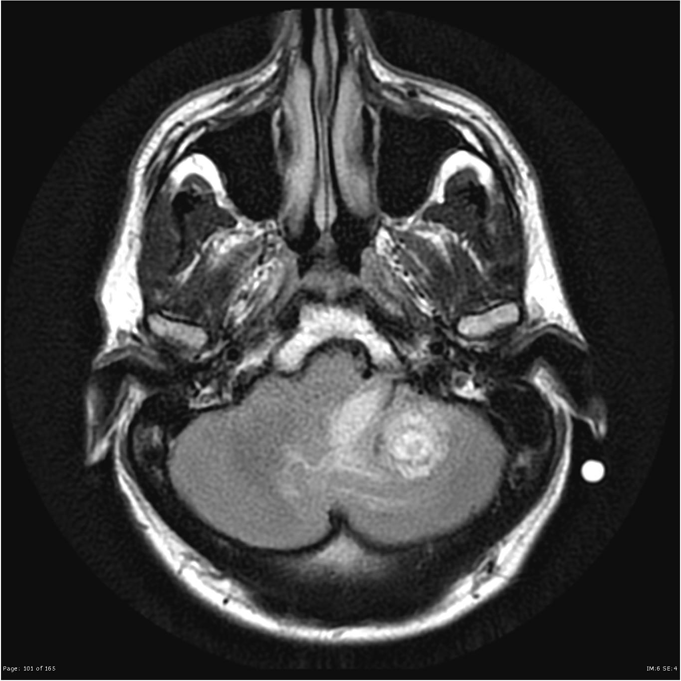 Von Hippel Lindau Disease - Multiple Hemangioblastomas | Image ...