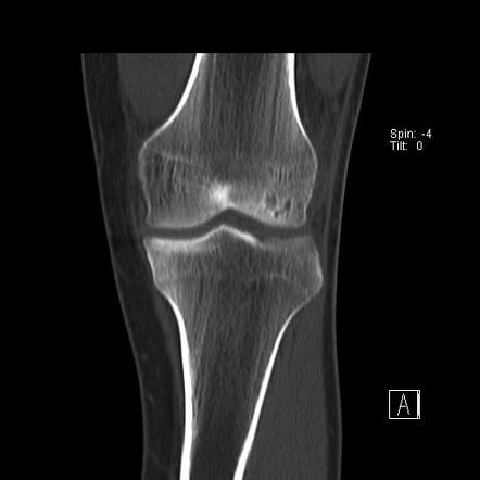 Osteochondritis dissecans (knee) | Image | Radiopaedia.org