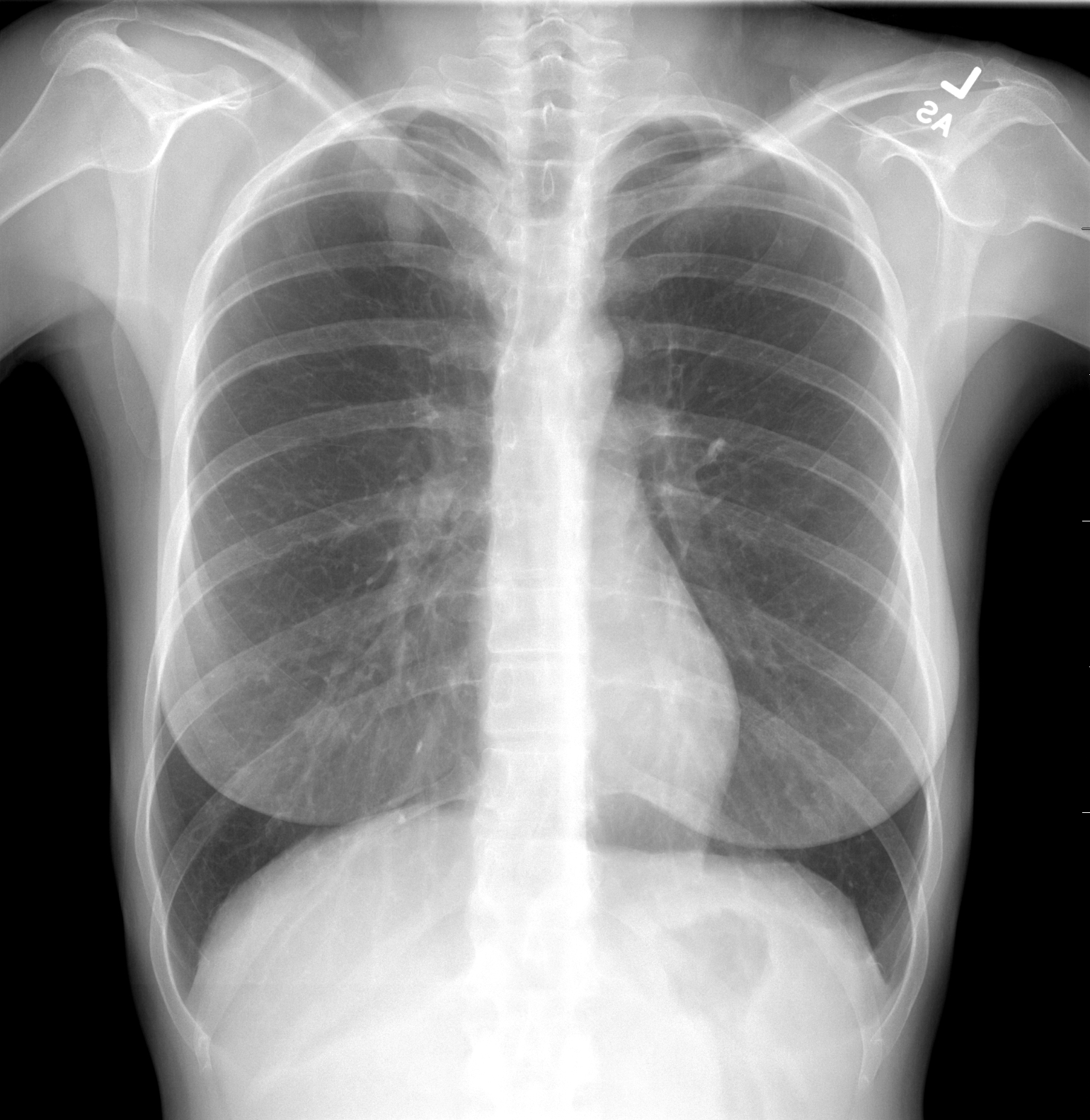 Pulmonary coccidiodomycosis | Image | Radiopaedia.org