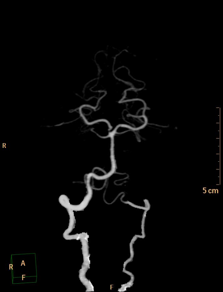 Hypoplastic vertebral artery with PICA termination | Image ...