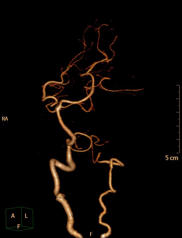 Hypoplastic Vertebral Artery Image Radiopaedia Org - vrogue.co