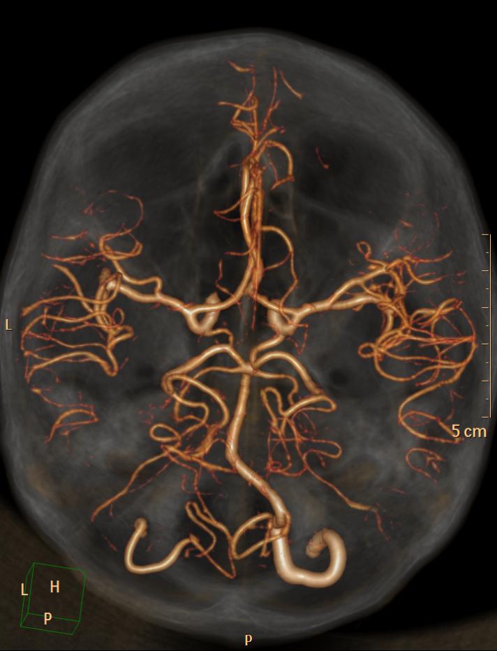 What is hypoplastic vertebral artery hypoplasia