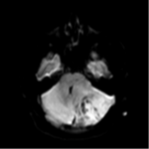 Medulloblastoma Image